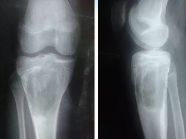 【PPT】骨肉瘤的影像诊断