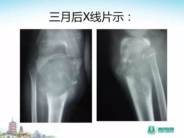 【PPT】骨肉瘤的影像诊断