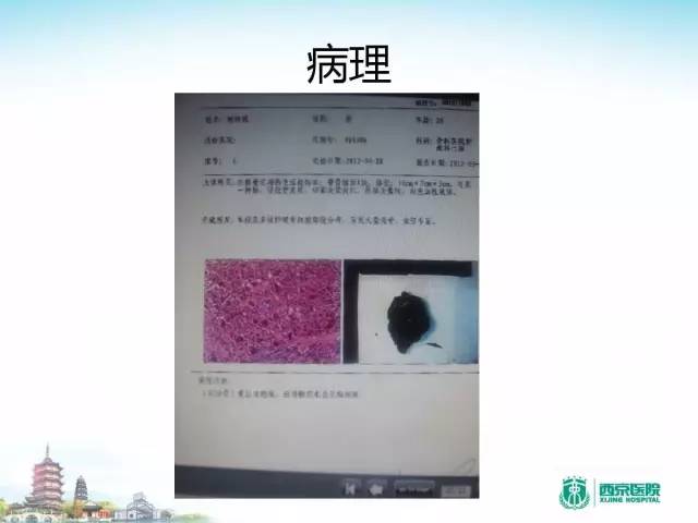 【PPT】骨肉瘤的影像诊断