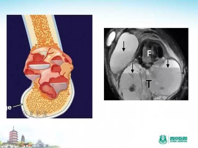 【PPT】骨肉瘤的影像诊断