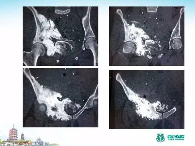 【PPT】骨肉瘤的影像诊断