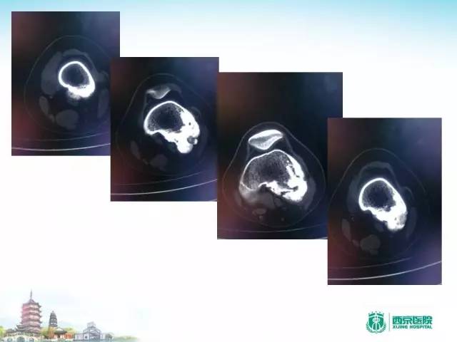 【PPT】骨肉瘤的影像诊断