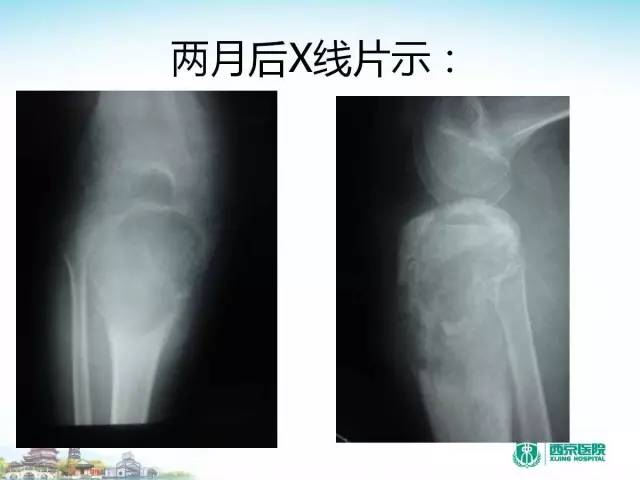 【PPT】骨肉瘤的影像诊断