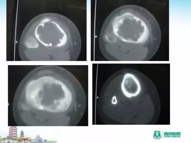 【PPT】骨肉瘤的影像诊断