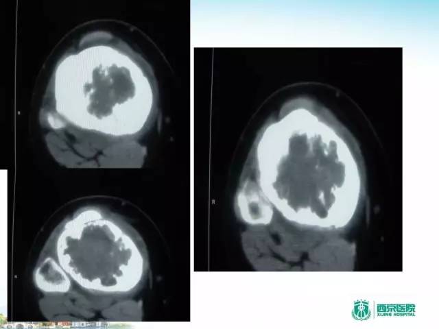 【PPT】骨肉瘤的影像诊断