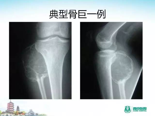 【PPT】骨肉瘤的影像诊断