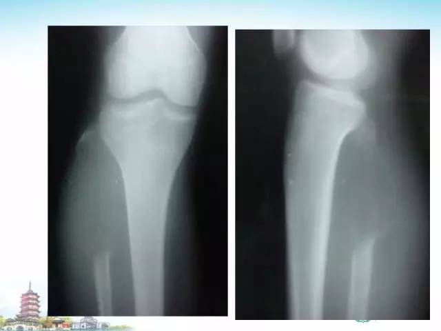 【PPT】骨肉瘤的影像诊断