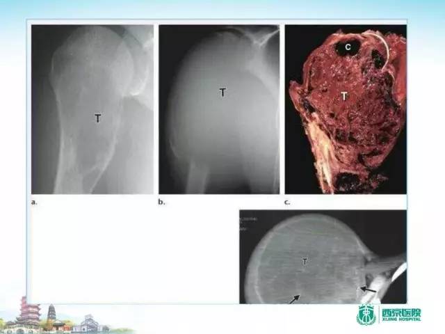 【PPT】骨肉瘤的影像诊断