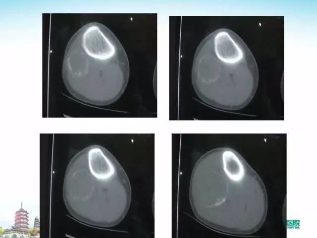 【PPT】骨肉瘤的影像诊断