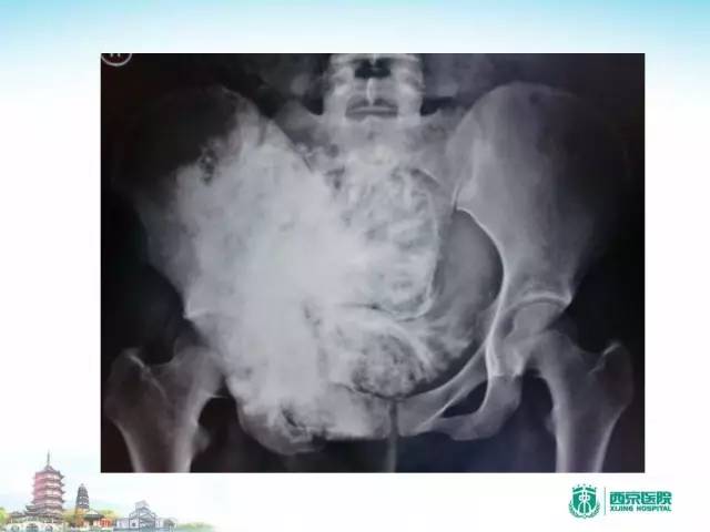 【PPT】骨肉瘤的影像诊断