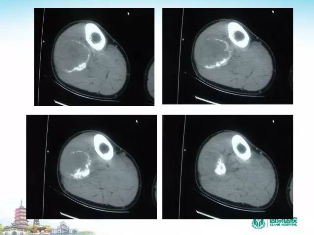 【PPT】骨肉瘤的影像诊断