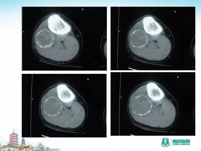 【PPT】骨肉瘤的影像诊断