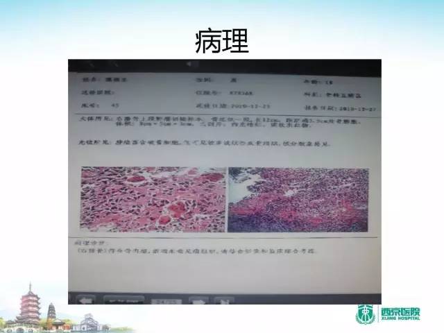 【PPT】骨肉瘤的影像诊断