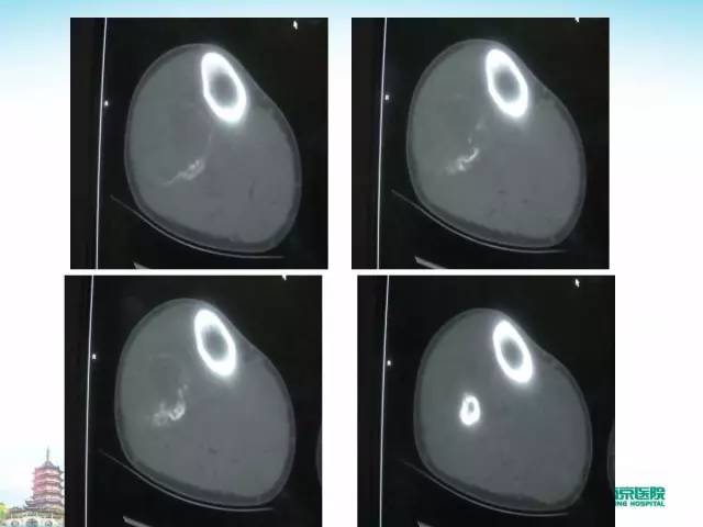 【PPT】骨肉瘤的影像诊断