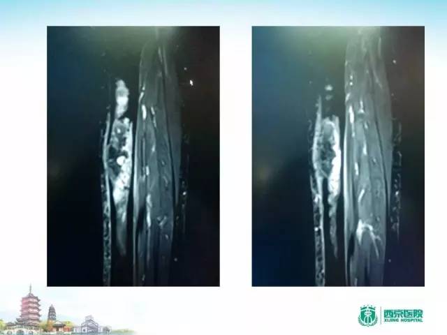 【PPT】骨肉瘤的影像诊断