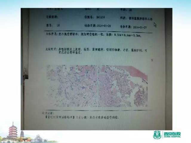 【PPT】骨肉瘤的影像诊断