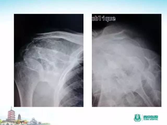 【PPT】骨肉瘤的影像诊断