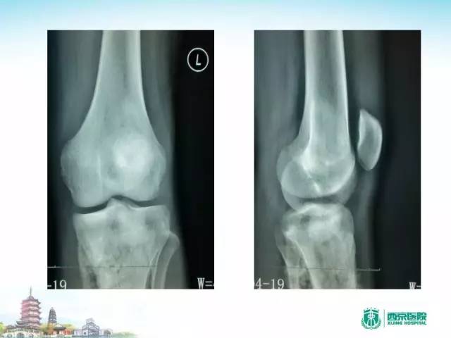 【PPT】骨肉瘤的影像诊断