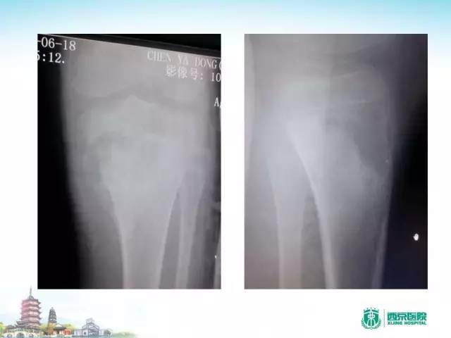 【PPT】骨肉瘤的影像诊断