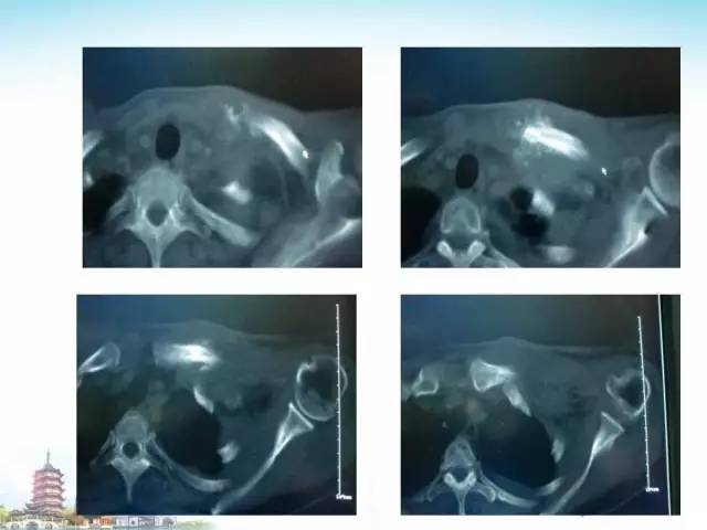 【PPT】骨肉瘤的影像诊断