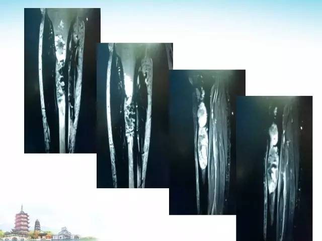 【PPT】骨肉瘤的影像诊断