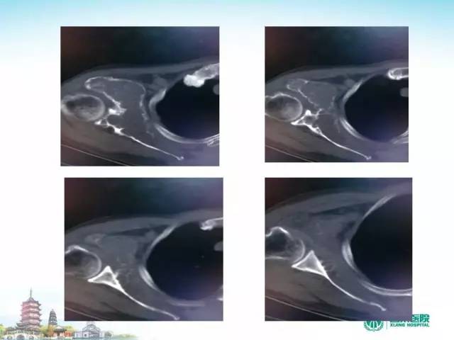 【PPT】骨肉瘤的影像诊断