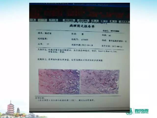 【PPT】骨肉瘤的影像诊断