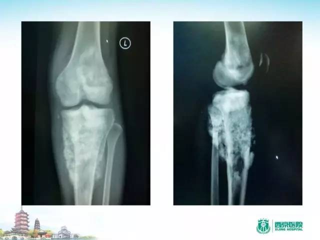 【PPT】骨肉瘤的影像诊断