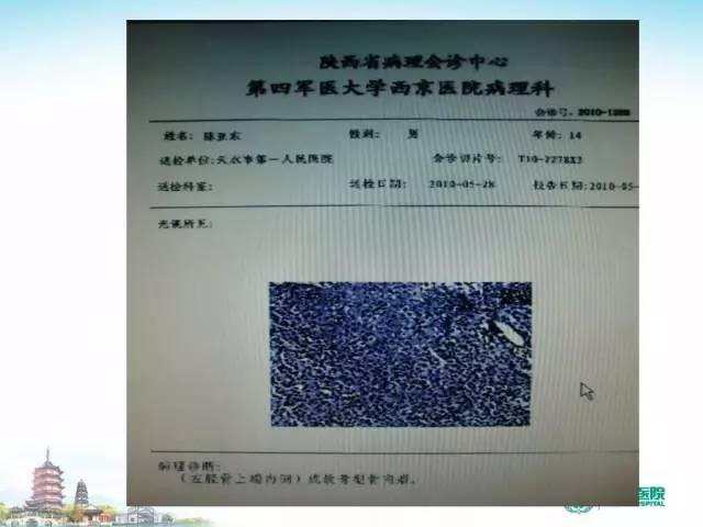 【PPT】骨肉瘤的影像诊断