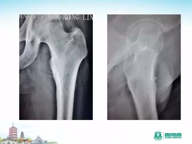 【PPT】骨肉瘤的影像诊断