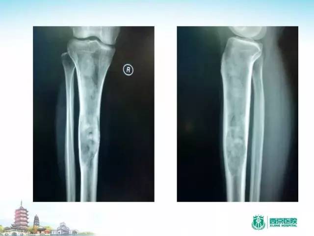 【PPT】骨肉瘤的影像诊断