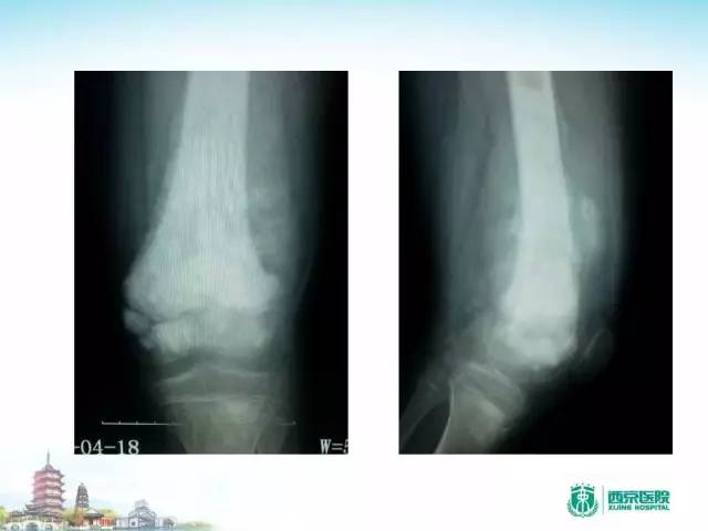 【PPT】骨肉瘤的影像诊断