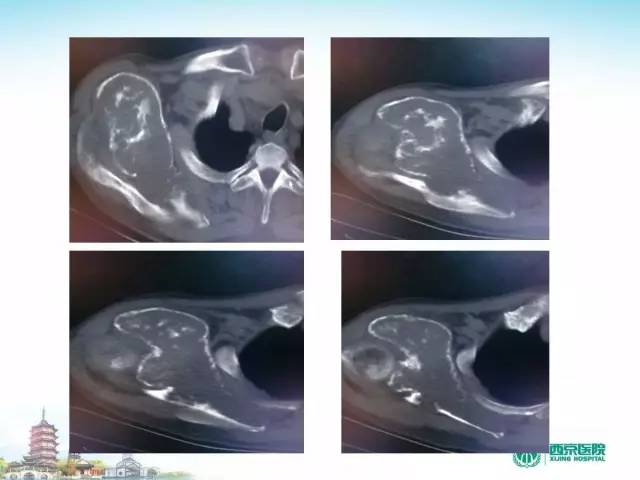 【PPT】骨肉瘤的影像诊断