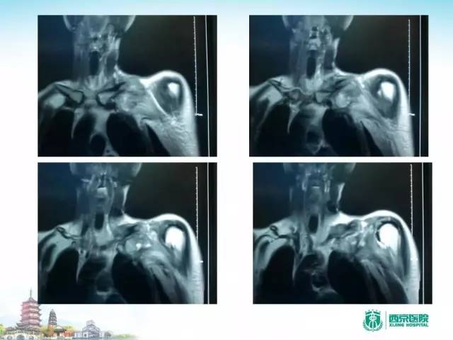 【PPT】骨肉瘤的影像诊断