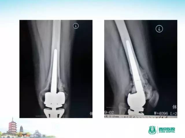 【PPT】骨肉瘤的影像诊断