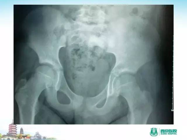 【PPT】骨肉瘤的影像诊断