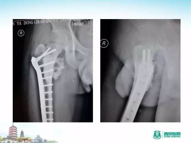 【PPT】骨肉瘤的影像诊断
