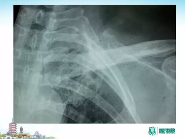 【PPT】骨肉瘤的影像诊断