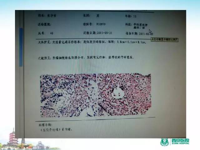 【PPT】骨肉瘤的影像诊断