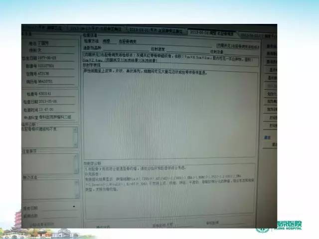 【PPT】骨肉瘤的影像诊断