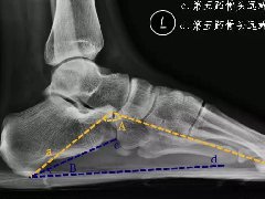 扁平足X线测量
