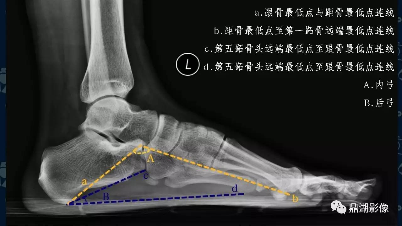 【PPT】扁平足X线测量