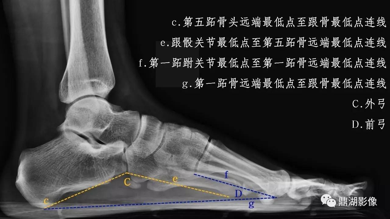 【PPT】扁平足X线测量