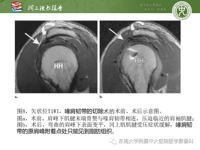 【PPT】术后肩关节MR及MR关节成像-正常与异常影像表现