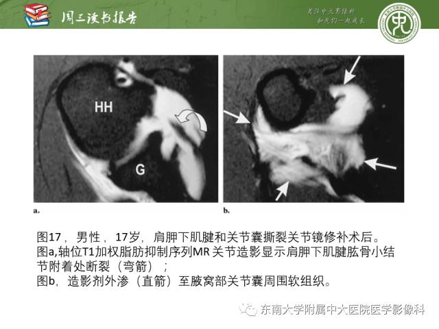 【PPT】术后肩关节MR及MR关节成像-正常与异常影像表现