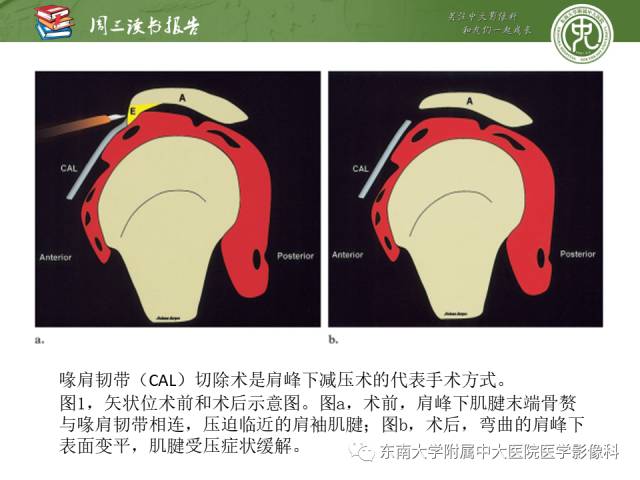 【PPT】术后肩关节MR及MR关节成像-正常与异常影像表现