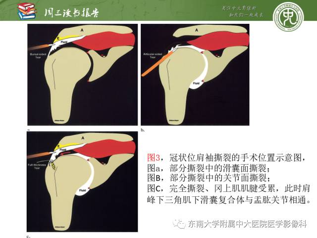 【PPT】术后肩关节MR及MR关节成像-正常与异常影像表现
