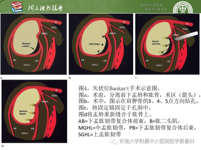 【PPT】术后肩关节MR及MR关节成像-正常与异常影像表现