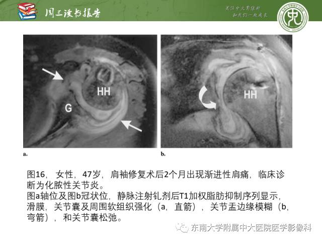 【PPT】术后肩关节MR及MR关节成像-正常与异常影像表现