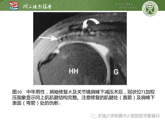 【PPT】术后肩关节MR及MR关节成像-正常与异常影像表现